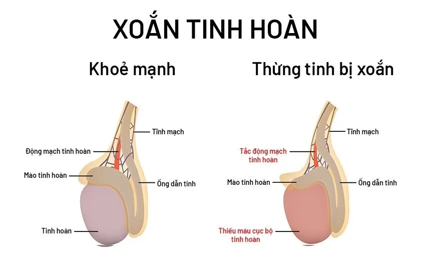 Xoắn tinh hoàn